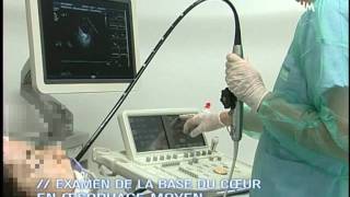 Echographie TransOesophagienne ETO  Film de formation [upl. by Arbas]