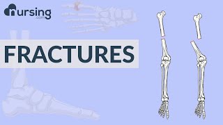 Fractures Nursing Care [upl. by Harvie]