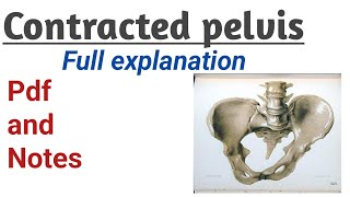 Contracted pelvis causes  symptoms and management [upl. by Ternan109]