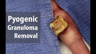 What are you holding Lets cut it off  Enormous Pyogenic Granuloma Removal  Dr Derm [upl. by Simeon663]