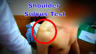 Identifying Inferior Shoulder Instability The Sulcus Test Explained 어깨 하방 불안정성 검사 Sulcus Test의 이해 [upl. by Cookie]