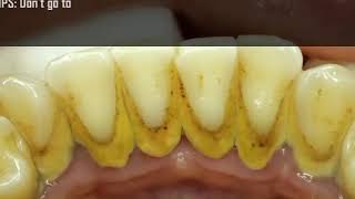 Ultimate Teeth Cleaning Treatment  Easy Tips for a Brighter Smile [upl. by Nesyla]