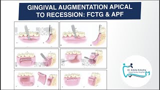 FREE CONNECTIVE TISSUE GRAFTS amp APICALLY POSITIONED FLAP GINGIVAL AUGMENTATION APICAL TO RECESSION [upl. by Aneles]