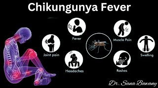 Chikungunya Fever Signs and SymptomsDiagnosis and Treatment [upl. by Nylek]