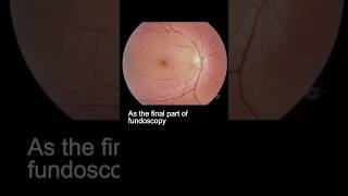 Examining the fundus – part 3 ophthalmology [upl. by Alaehcim]