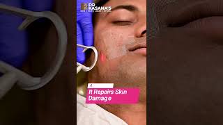 co2 laser treatment for acne scars  DrLalit Kasanas [upl. by Nagek]