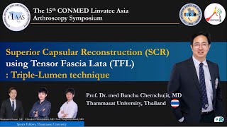 SCRSuperior Capsular Reconstruction ConMed Linvatec CLASS Meeting Cebu ProfBanchaChernchujit [upl. by Atteloiv]