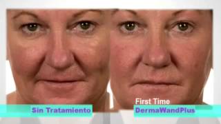 derma wand plus resultados [upl. by Ansev231]