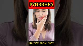 Pyorrhea Treatment At Home  Periodontitis Treatment  pyorrhea symptoms  BY Dr Sanjay Sundriyal [upl. by Tracie]