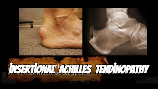 Why Achilles Tendinopathy Happens and How to Fix It [upl. by Anisamot]