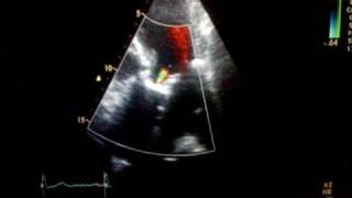 Aortic regurgitation combined with stenosis Ultrasound echocardiography [upl. by Leehar]