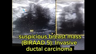 ultrasound of suspicious breast mass BIRAD 5 Invasive ductal carcinoma [upl. by Doralynne]