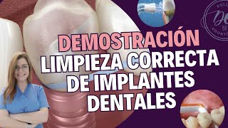 Como LIMPIAR los IMPLANTES DENTALES para mantenerlos SANOS  🦷💦 [upl. by Hazlett481]