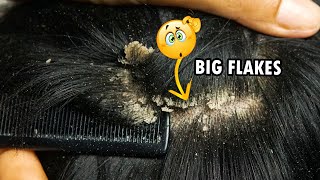 Dandruff Scratching Big Flakes Dandruff Removal Satisfying 289 [upl. by Girhiny]