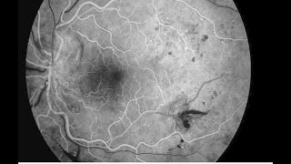 Fluorescein angiography and diabetic retinopathy [upl. by Hardi474]