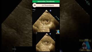 Intracardiac Thrombosis LV Atrial contrast [upl. by Bronwyn48]