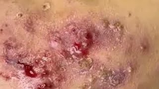 SEVERE CYSTIC ACNE Removal 😲 Crusty Scabs on Cheeks Hana Spa [upl. by Thorr506]