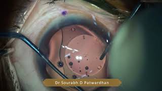 IPCL eyepcl caregroup phakic IOL insertionToric and star dr Sourabh Patwardhan [upl. by Karen]