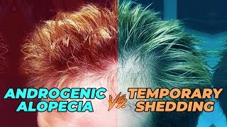 How To Test If Your Hair Loss Is Androgenic Alopecia Or Temporary Shedding [upl. by Akimet86]