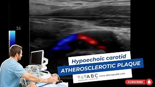 Hypoechoic carotid atherosclerotic plaque [upl. by Adne]