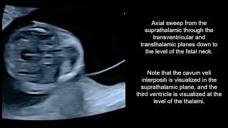 The prevalence and evolution during the firsttrimester of the cavum veli interpositi [upl. by Edmondo]