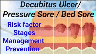 FON  Decubitus Ulcer Pressure Sore Bed Sore Pressure Ulcer NORCET AIIMS RRB nandanio4t [upl. by Namyw906]