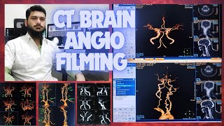 CT SCAN BRAIN ANGIOGRAPHY FILMING PROCESS ON PHILIPS INGENUITY MACHINE SOFTWARE  Circle of willis [upl. by Yenar372]