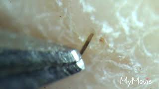 Satisfying Ingrown Hair Plucking Compilation 2 [upl. by Chas]