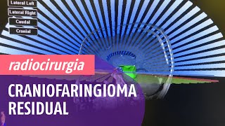 Radiocirurgia para Craniofaringioma Residual em crescimento [upl. by Balas829]