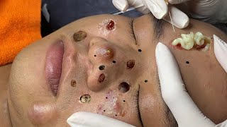 blackheads new 2023  popping pimple today  blackheads and whiteheads removal [upl. by Garcia]