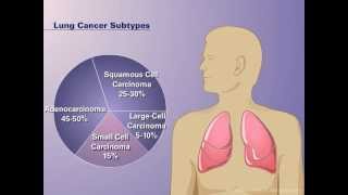 The Pathophysiology of Nonsmall Cell Lung Cancer [upl. by Ynohtnanhoj597]