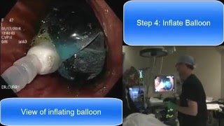 Orbera Gastric Balloon Live 2016Dr Trace Curry Cincinnati Ohio [upl. by Nnylyar]