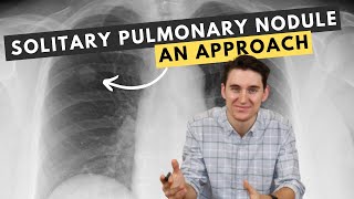 My approach to solitary pulmonary nodules [upl. by Edi]