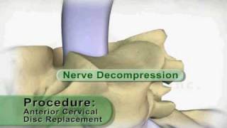 Artificial Cervical disc Replacement [upl. by Shandeigh427]