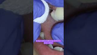 Milk Tooth Extraction  Best Dental Clinic in Rohtak dentist dentalclinic [upl. by Arly849]