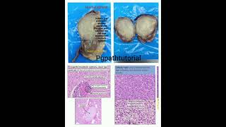 Crisp summary of congenital mesoblastic nephroma a NTRK positive tumor [upl. by Dewees]