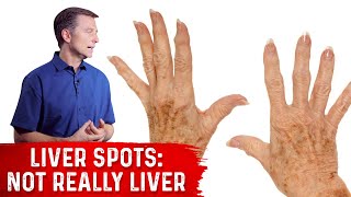 What Causes Liver Spots Age Spots – Dr Berg on Vitamin C Deficiency [upl. by Whitman]