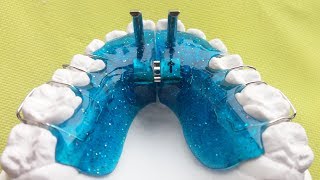 Vorschubdoppelplatte Angle 2 Sander 2 DoppelVorschubplatte Double Plate KFO Orthodontics [upl. by Eerej]