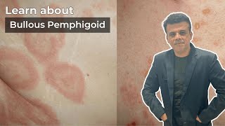 Breaking Down Bullous Pemphigoid Symptoms Causes and Solutions  Pathology Navigatorpathology [upl. by Ruffi652]