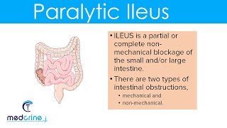 Paralytic Ileus  causes pathophysiology clinical features diagnosis and treatment [upl. by Artima]