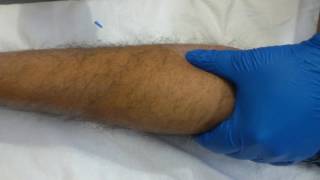 Dry Needling Technique for Calf gastronemius  Plantar Fascitis heel pain calcaneum position [upl. by Yruoc573]