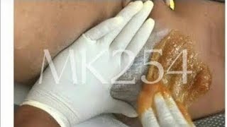 BRAZILIAN BIKINI LINE SUGARING SUGAR WAXINGbrazilian waxing wax sugaring sugarwaxing [upl. by Dianna918]