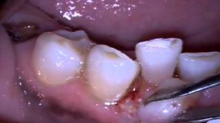 MD Epulis Removal [upl. by Bernette812]