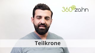 Teilkrone  Was ist eine Teilkrone  DentalLexikon  360°zahn [upl. by Older541]