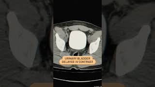 Urinary Bladder Delayed IV Contrast viral biology ctscan [upl. by Christine]