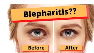 Blepharitis How to treat Blepharitis Best Home Treatment [upl. by Meir]