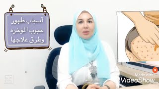 الحل النهائى لعلاج حبوب المؤخره [upl. by Dorthy]