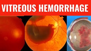 VITREOUS HEMORRHAGE  Everything you need to know [upl. by Lubin644]