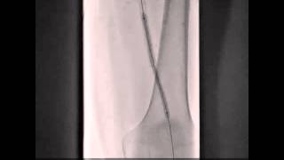 Ipsilateral Femoral Access Cryoplasty of Left SFA Instent Restenosis [upl. by Windsor461]