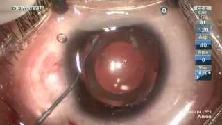 Phakic IOL  STAAR ICL implantation in a very high myopia young pt 20D by Dr Bryan Lin [upl. by Meibers]